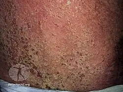[9] Rash associated with Darier's disease