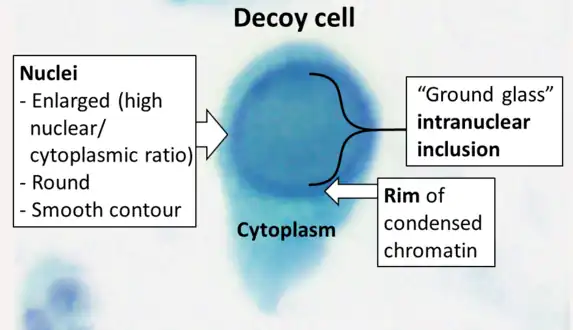 Cytology of a polyomavirus infected cell, using Papanicolaou stain. The high nuclear to cytoplasmic ratio makes it resemble cancer (thus the name "decoy cell") but the inclusion body reveals its viral pathophysiology.
