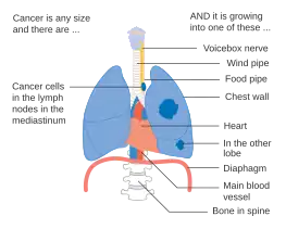 Stage IIIB lung cancer