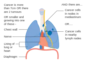 Stage IIIA lung cancer, if there is one feature from the list on each side