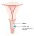 A local surgery to remove vaginal cancer