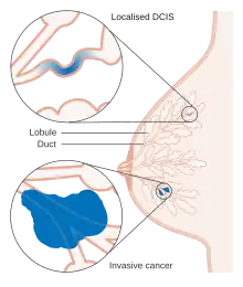 Diagram showing ductal carcinoma in situ (DCIS)[12]