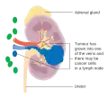 Stage 3 kidney cancer