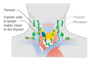 Stage N1a thyroid cancer