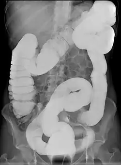 Black-and-white X-ray image of abdomen, showing an atypically-long large intestine. The intestine appears bright and opaque in contrast to the rest of the image.