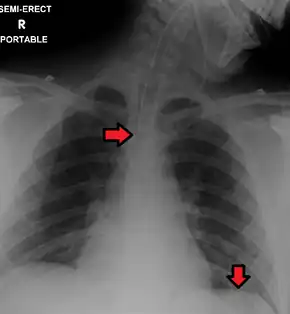 Portable chest (ie, antero-posterior view) showing endotracheal tube and Levin tube, both properly in place.