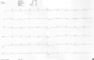 A 10-lead ECG of a woman with Ebstein's anomaly: The ECG shows signs of right atrial enlargement, best seen in V1. Other P waves are broad and tall, these are termed "Himalayan" P waves. Also, a right bundle-branch block pattern and a first-degree atrioventricular block (prolonged PR-interval) due to intra-atrial conduction delay are seen. No evidence of a Kent-bundle is seen in this patient. The T wave inversion in V1-4 and a marked Q wave in III occur; these changes are characteristic for Ebstein's anomaly and do not reflect ischemic ECG changes in this patient.