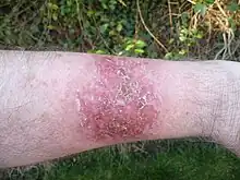 Effect of topical skin treatment with 5-fluorouracil cream after 30-day, before commencement of the healing phase (months two and three)