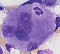 Emperipolesis: Megakaryocyte containing a segmented neutrophil, stained with a May-Grünwald Giemsa stain.