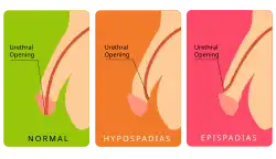 Normal versus epispadias and hypospadias
