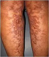 Lace-like dark patches with a few, scattered, red spots