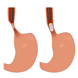 Esophagal Bougie Dilator
