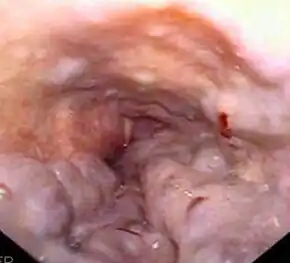 Gastroscopy image of esophageal varices with prominent cherry-red spots