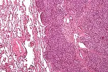Micrograph of a metastatic Ewing sarcoma with the characteristic cytoplasmic clearing on H&E staining, which was showing to be PAS positive