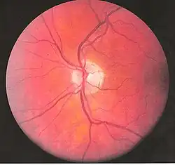 Left eye blood vessels