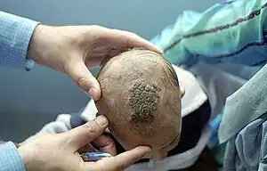 A large brown colored plaque on the top of a child's head