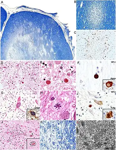 a-l)Histopathological features of PML[18]