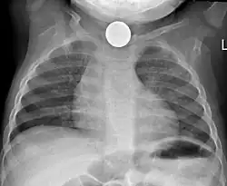 Foreign body in the esophagus causing airway compromise.