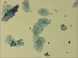 Microscopic picture of vaginal epithelial clue cells coated with Gardnerella vaginalis, magnified 400 times
