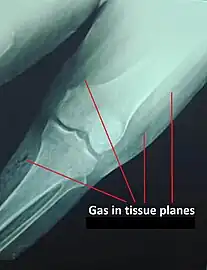 Plain X-Ray of a patient with gas gangrene of left leg