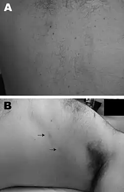 a,b)Gnathostomiasis in a 37-year-old male