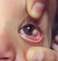 Limbal dermoid as seen in Goldenhar syndrome