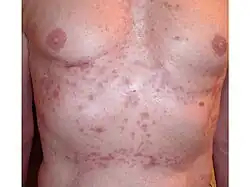 Advanced case, fifth month