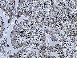 Immunohistochemistry of breast cancer (Infiltrating ductal carcinoma of the breast) assayed with anti HER-2 (ErbB2) antibody.