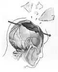 Trajectory of the missile through President Kennedy's skull. The bullet struck posterior part of his right parietal bone from behind.