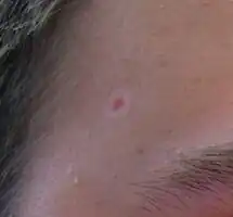 Photograph of a halo nevus on a face