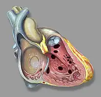 Heart anatomic view of right ventricle and right atrium with example ventricular septal defects