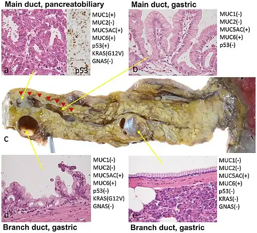 Histopathology of IPMN types in a distal pancreatectomy specimen from a 60-year-old man, by gross pathology (center image), microscopy and immunohistochemistry: The resected specimen (c) revealed that the mural nodule in the MPD consisted of PB-type IPMN with high-grade dysplasia (adenocarcinoma) (a) with a diffuse positivity of p53 immunostaining (an insert) and KRAS mutation (G12V). The BD-IPMN of the body was lined by gastric mucinous epithelium showing low papillary configuration with mild epithelial stratification with the same KRAS mutation (d), and the proliferation of similar gastric IPMN components sequentially involved the bottom of the mural nodule and the wall of the surrounding dilated MPD (indicated by red arrowheads) (b). The BD-IPMN of the tail was lined by flat, monolayer gastric mucinous epithelium lacking cellular atypia and KRAS mutation (e).[5]