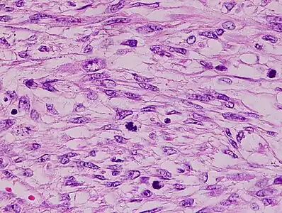 Histopathology of leiomyosarcoma shows variable atypia, often with cytoplasmic vacuoles at both ends of nuclei, and frequent mitoses.[11]