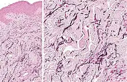 Histopathology: Accumulation of fragmented elastotic material within the papillary dermis and transcutaneous elimination of elastotic fibers.