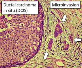 DCIS with microinvasion, defined as focus of invasive cancer measuring up to 1.0&nbsp;mm in size.[28]