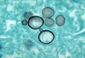 Paracoccidioides histopathology