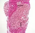 Histopathology of steatohepatitis with established cirrhosis, with thick bands of fibrosis (Van Gieson's stain)[40]