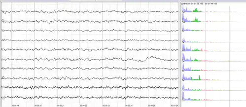 Human EEG with in resting state. Left: EEG traces (horizontal – time in seconds; vertical – amplitudes, scale 100&nbsp;μV). Right: power spectra of shown signals (vertical lines – 10 and 20&nbsp;Hz, scale is linear). 80–90% of people have prominent sinusoidal-like waves with frequencies in 8–12&nbsp;Hz range – alpha rhythm. Others (like this) lack this type of activity.