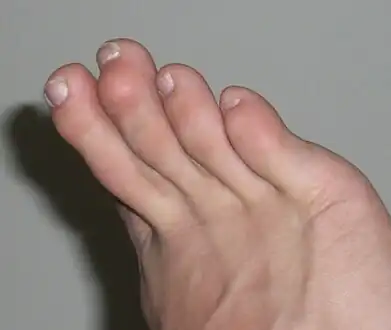 A mallet toe is evident on the 3rd digit.