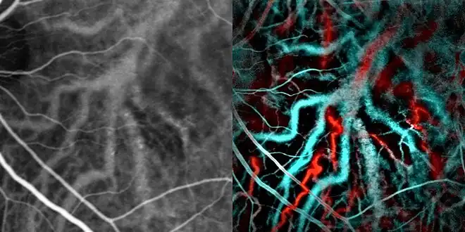 Indocyanine green angiography (left) and laser Doppler imaging (right) of the macula in central serous retinopathy, revealing choroidal vessels. Blue and red correspond ot low and high blood flow respecively.[20]