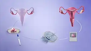 A depiction of the procedure of in-vitro fertilization