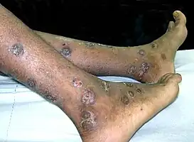 Impetigo rash