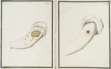 Comparison of smallpox (left) and cowpox inoculations sixteen days after administration (1802)