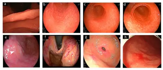 Different endoscopic patterns related to H. pylori infection.[106]