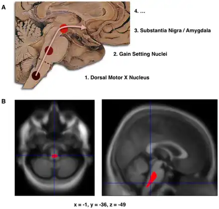 a)Schematic initial progression of Lewy body deposits in the first stages of Parkinson's disease, as proposed by Braak and colleagues, b)Localization of the area of significant brain volume reduction in initial PD compared with a group of participants without the disease in a neuroimaging study, which concluded that brainstem damage may be the first identifiable stage of PD neuropathology[68]