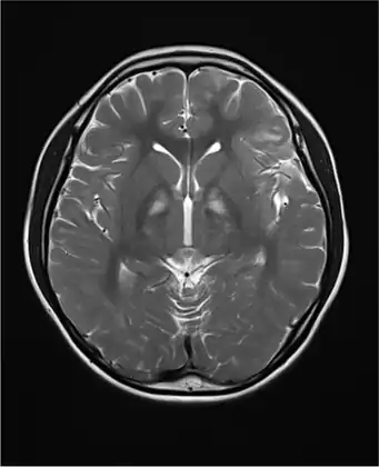 Brain MRI indicated diffuse demyelinating lesions in white matter of both cerebral hemispheres