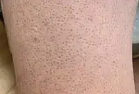 Keratosis pilaris on lower leg