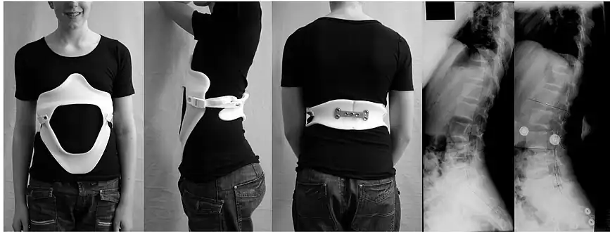 Modern brace for the treatment of lumbar or thoracolumbar kyphosis. The brace is constructed using a CAD/CAM device. Restoration of the lumbar lordosis is the main aim.[17]