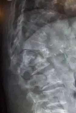 Multiple osteoporotic wedge fractures demonstrated on a lateral thoraco-lumbar spine X-ray