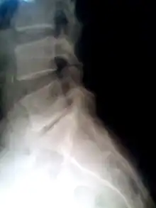 Narrowed space between L5 and S1 vertebrae, indicating probable prolapsed intervertebral disc – a classic picture